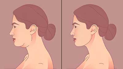 Troubled With Face Fat? Here Is How You Can Get Rid Of Facial Fat